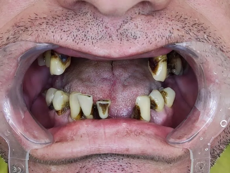 patient 1 - dental implants - all on 4 - all on 5 - pre