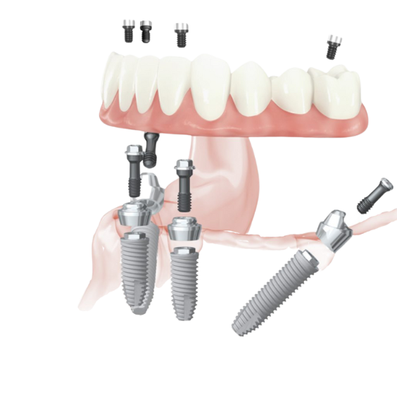 all on 4 dental implants