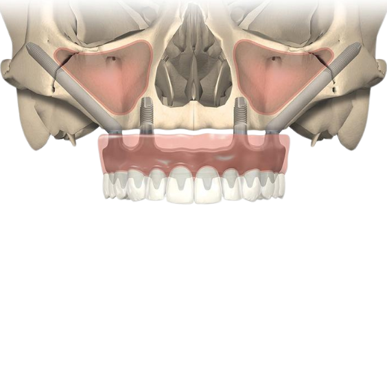 zygomatic dental implants