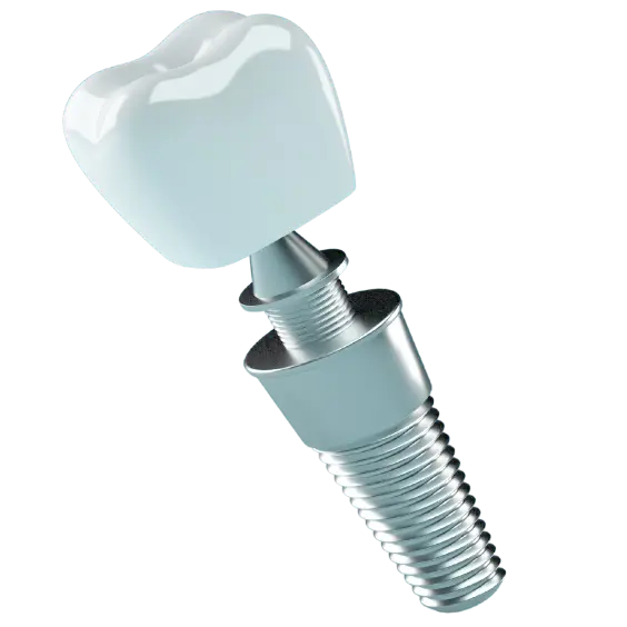 dental implant