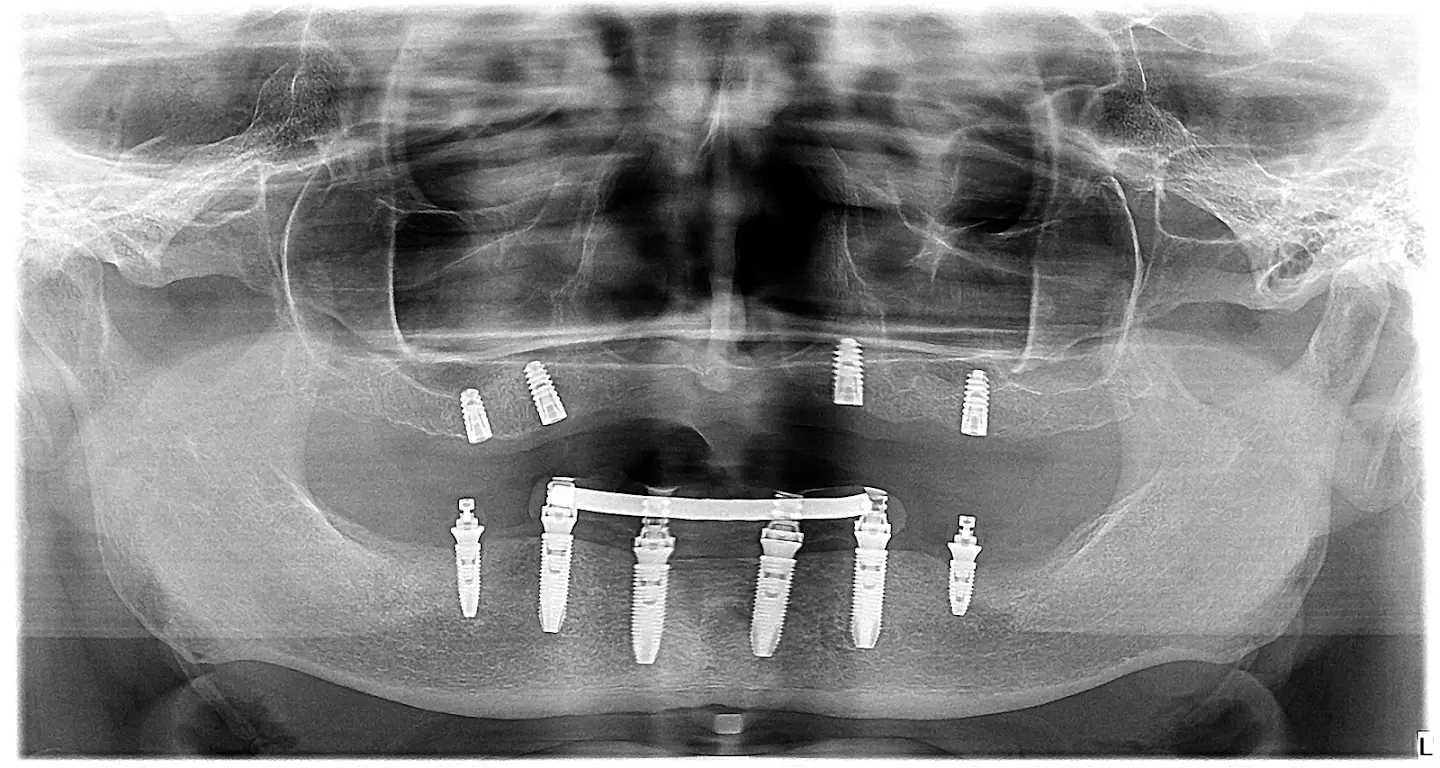 ksenia - opt shot - all on 6 all on 4 dental implants