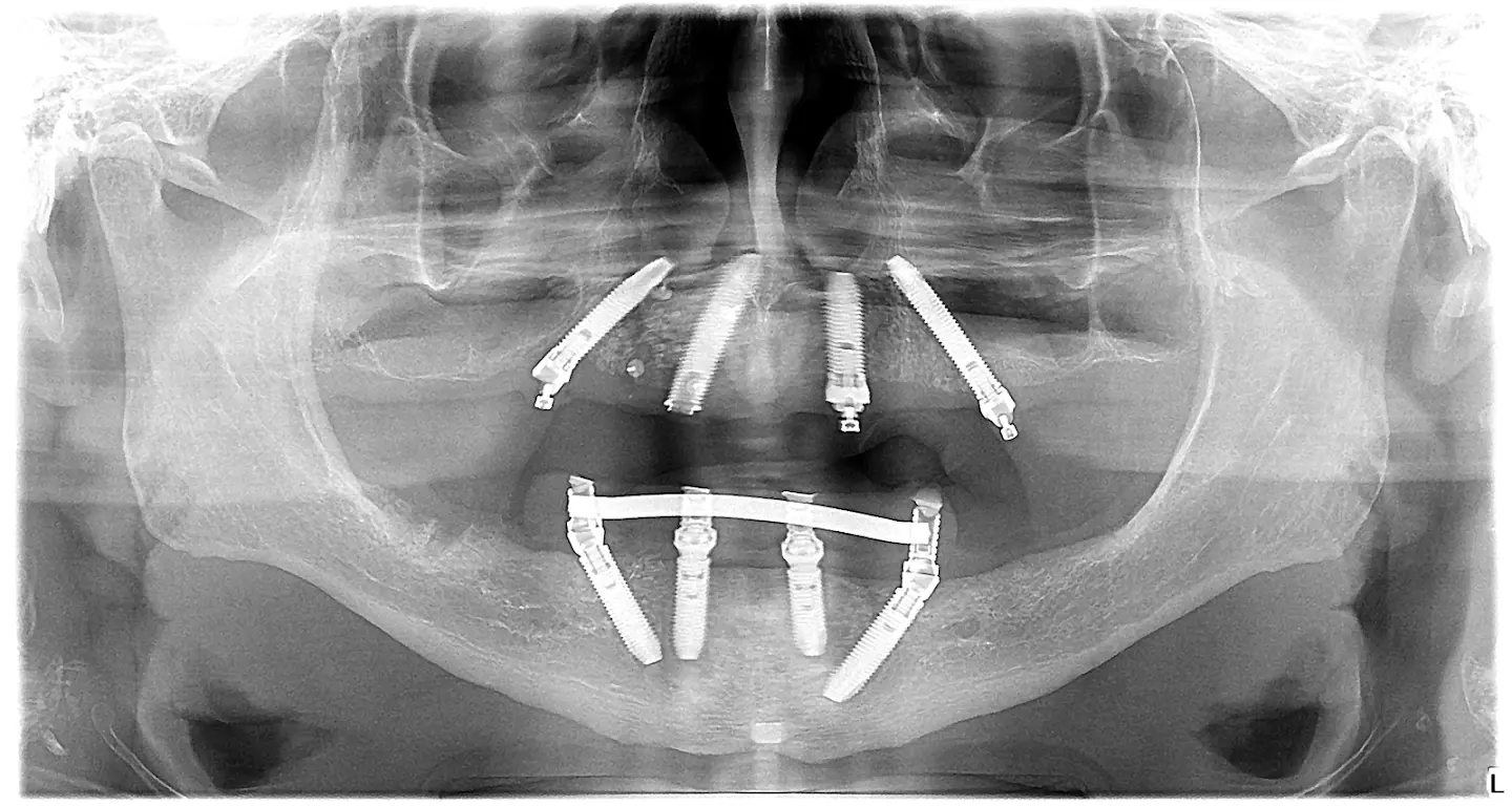 case 2 - OPT - all on 4