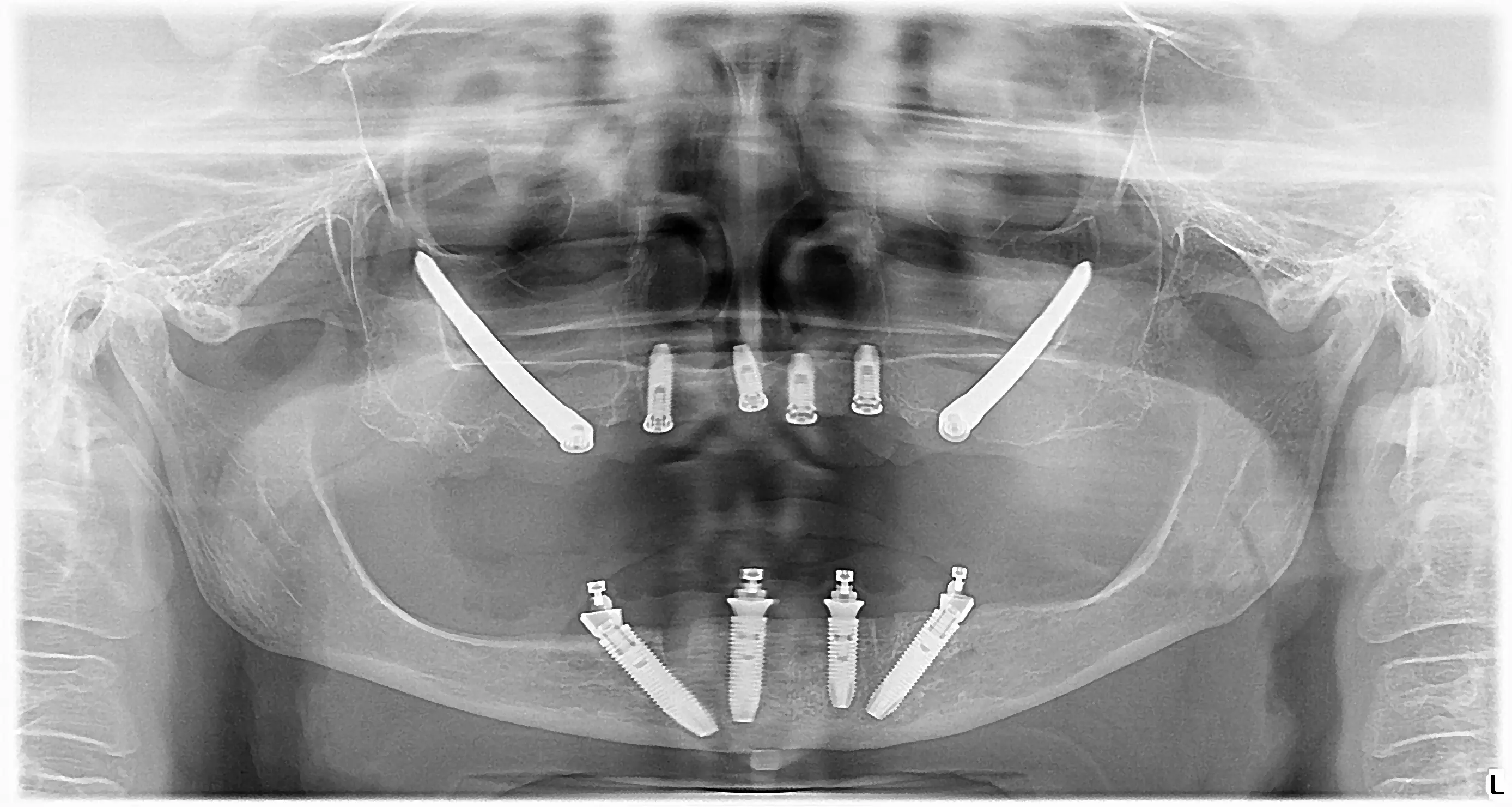 OPT image zygomatic implants all on 6 all on 4