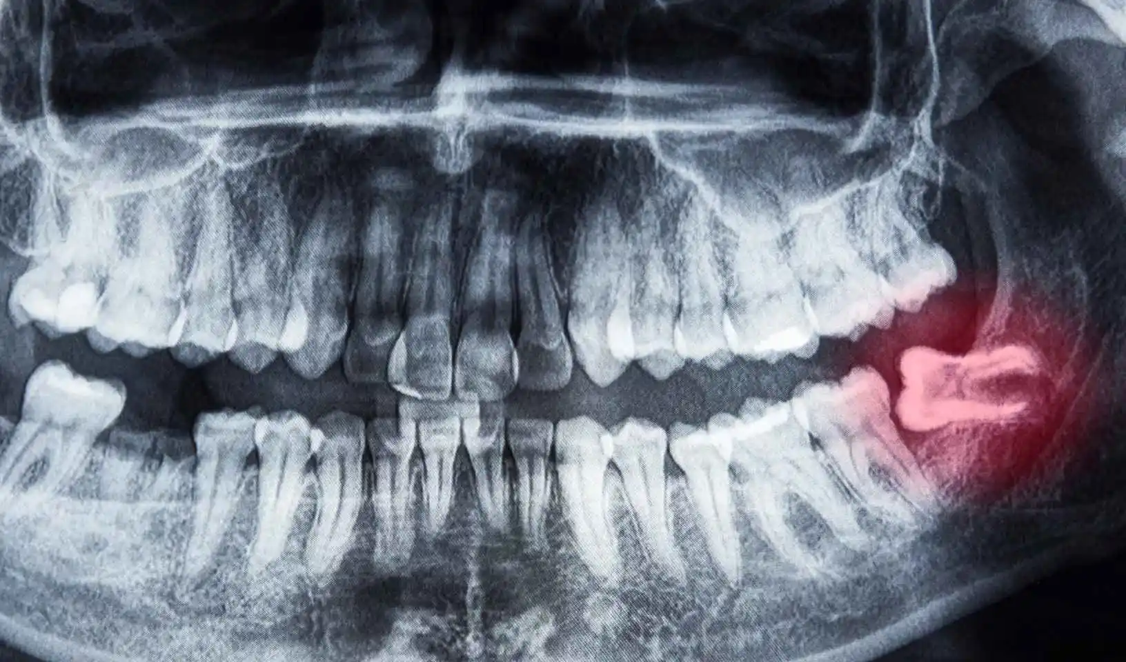 wisdom tooth extraction new now